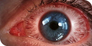 Retinal Diseases treatment hoshiarpur